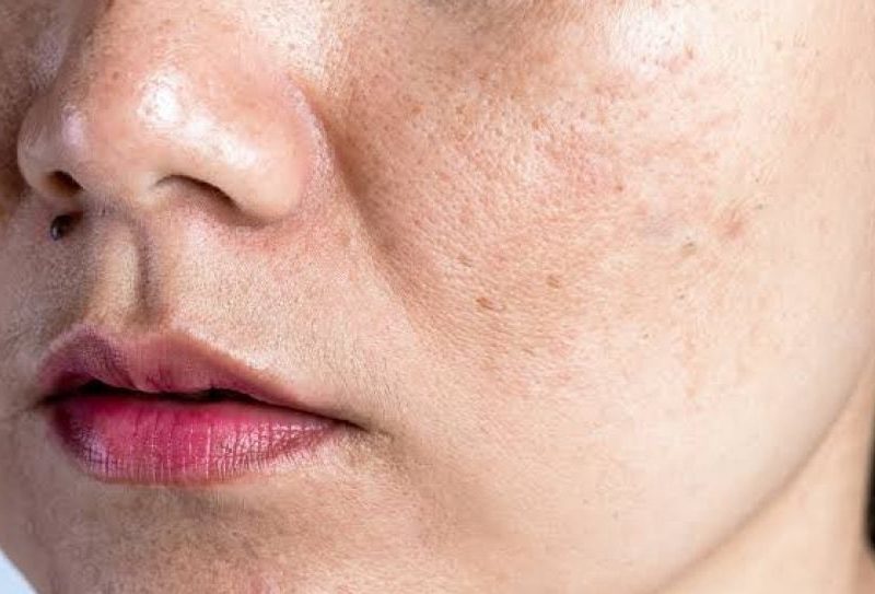 Flek Hitam Pada Wajah Membuat Seseorang Insecure